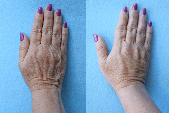 Hand Rejuvenation Before & After Photos Right Side