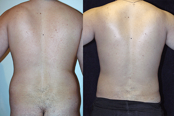 Abdomen, and Chest Liposuction Before & After Photos Back