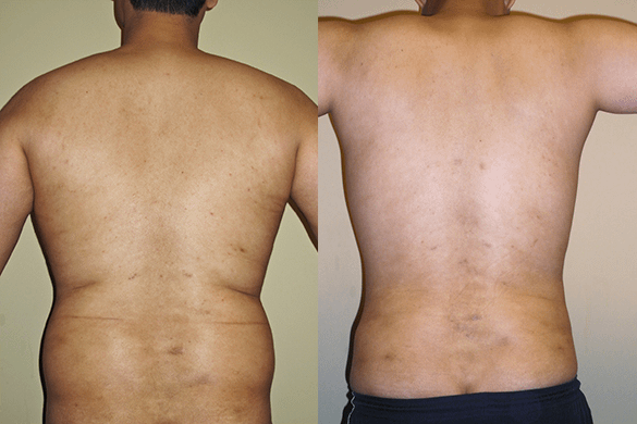 liposuction orange county Before & Afte Photos Back
