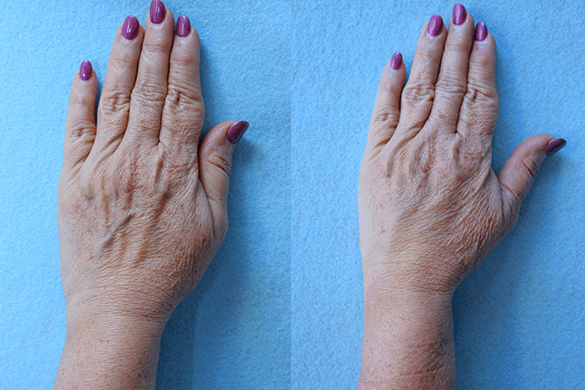 Hand Rejuvenation Before & After Photos Left Side