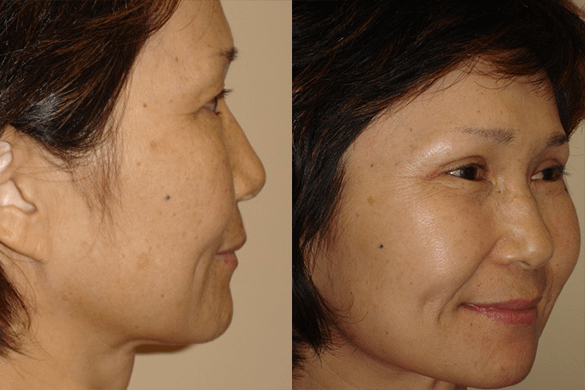 Laser Resurfacing Before & After Photos Right Side