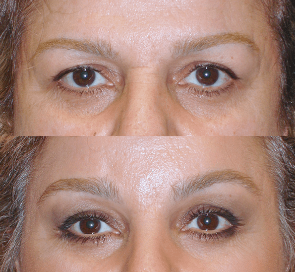 Brow Lift Before & After Photos