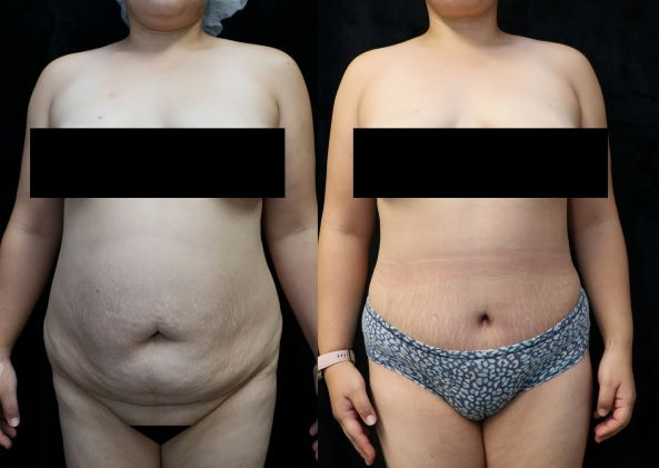 abdominoplasty front before and after