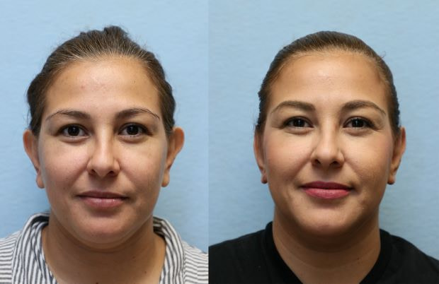 OTOPLASTY ORANGE COUNTY before and after