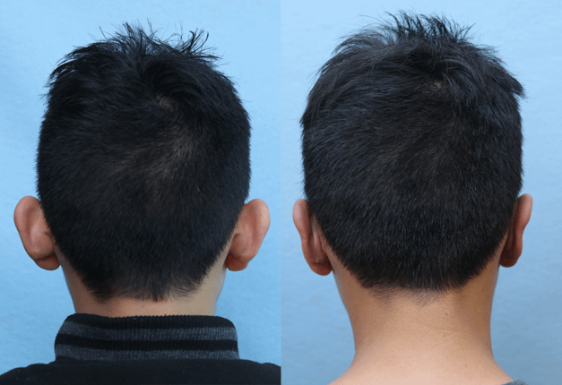 Ear Pinning for Men Before & After Photos Back Side