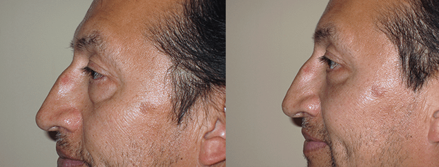 Eyelid Surgery Before & After Photos Left
