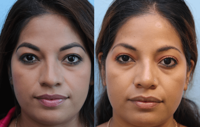 rhinoplasty Before & After Photos