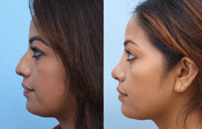 rhinoplasty Before & After Photos Left Side
