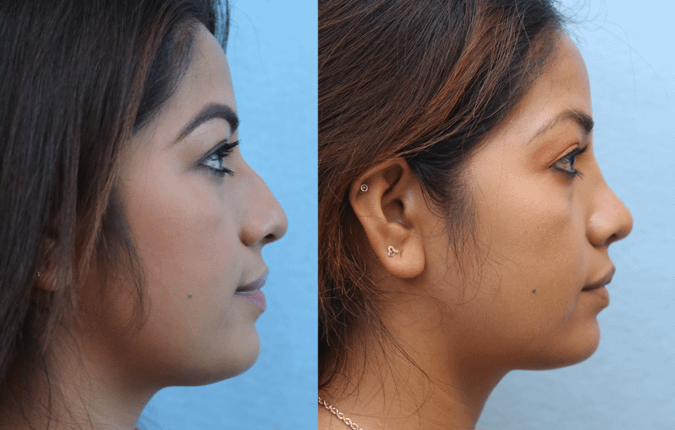 rhinoplasty Before & After Photos Right Side