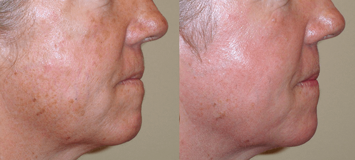 Laser Resurfacing Before & After Photos Right side