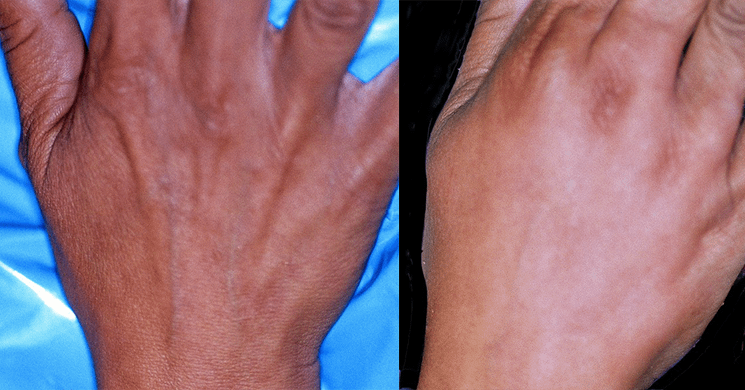 Hand Rejuvenation Before & After Photos