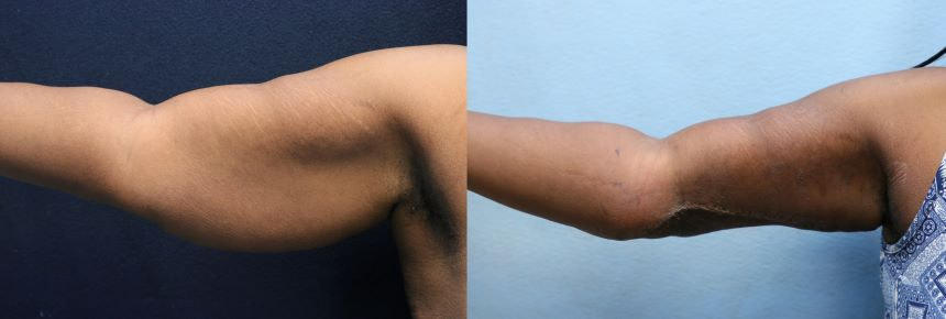 arm lift- arm liposuction- before and after