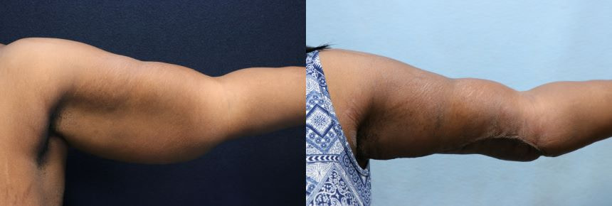 arm lift- arm liposuction before and after