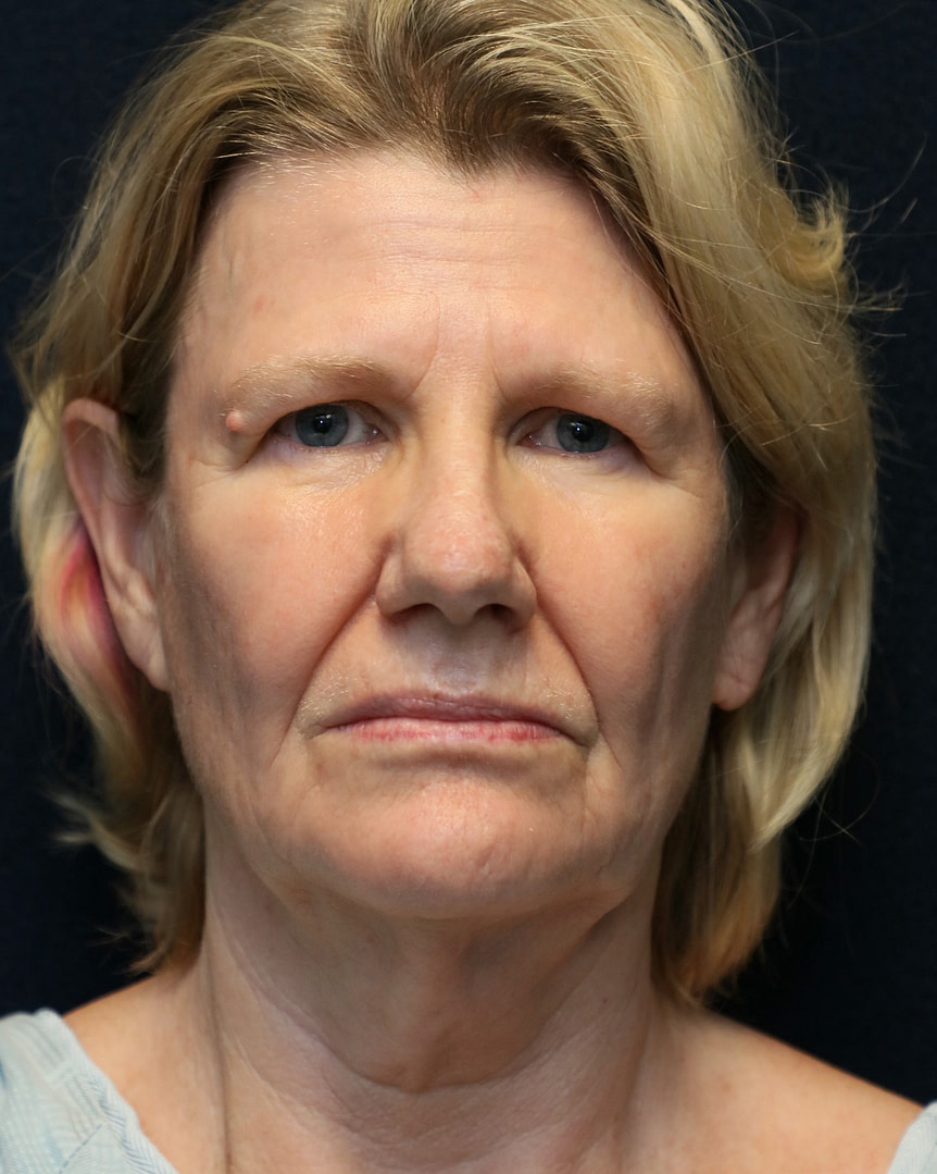 face lift neck lift before photo