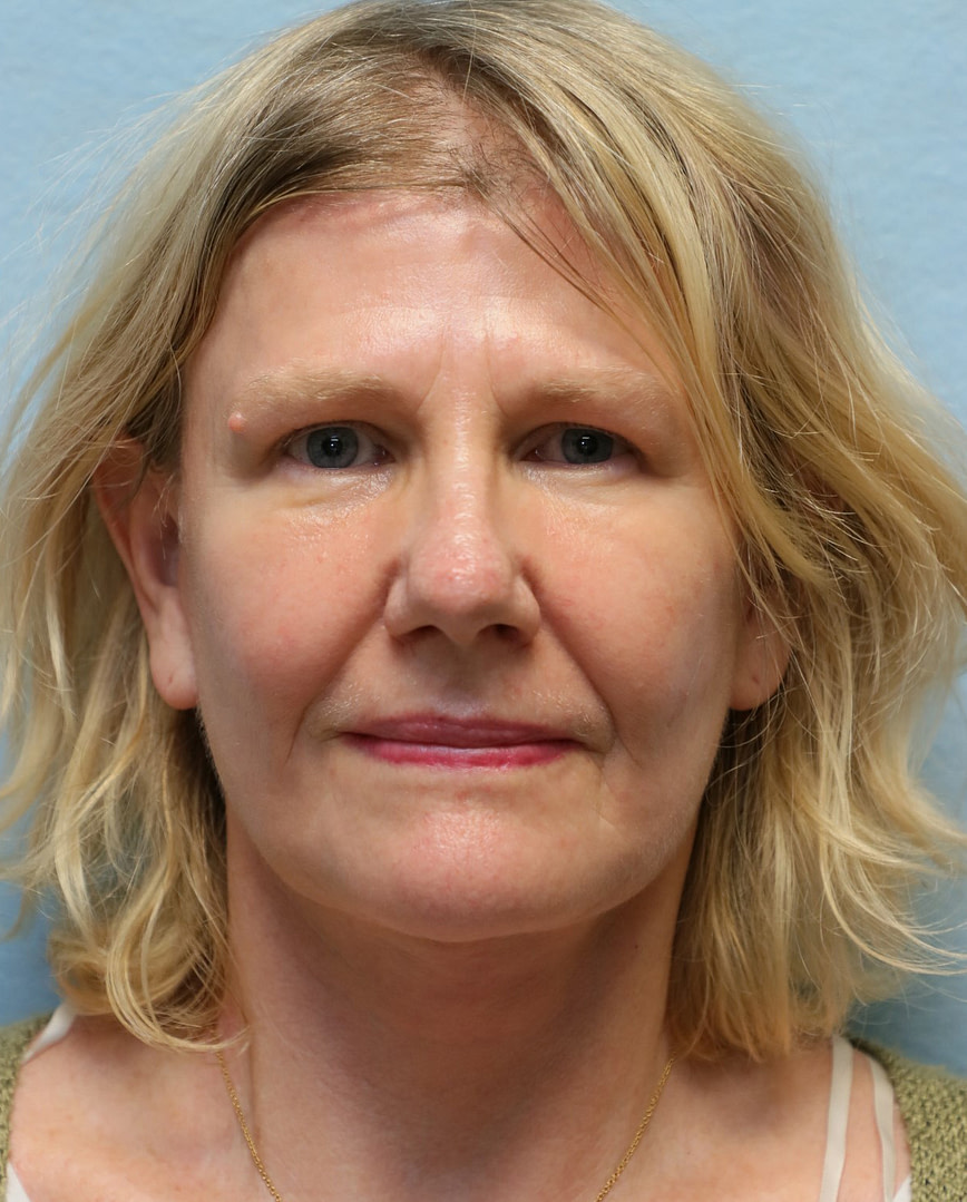 face lift neck lift after photo