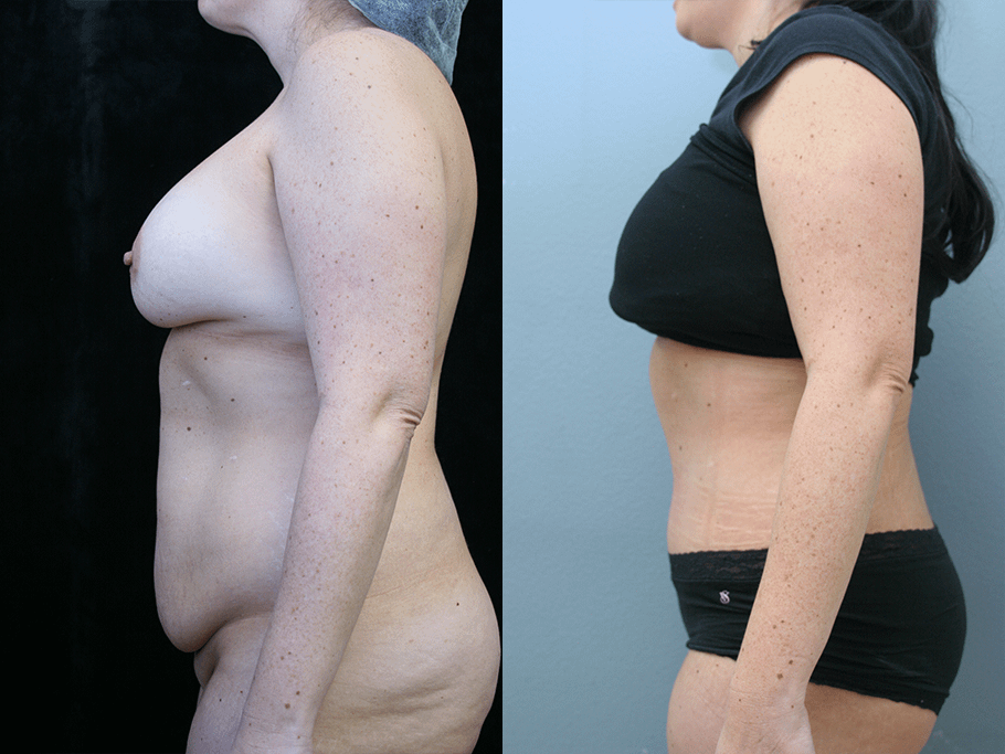 Tummy Tuck Before & After Photos Left Side