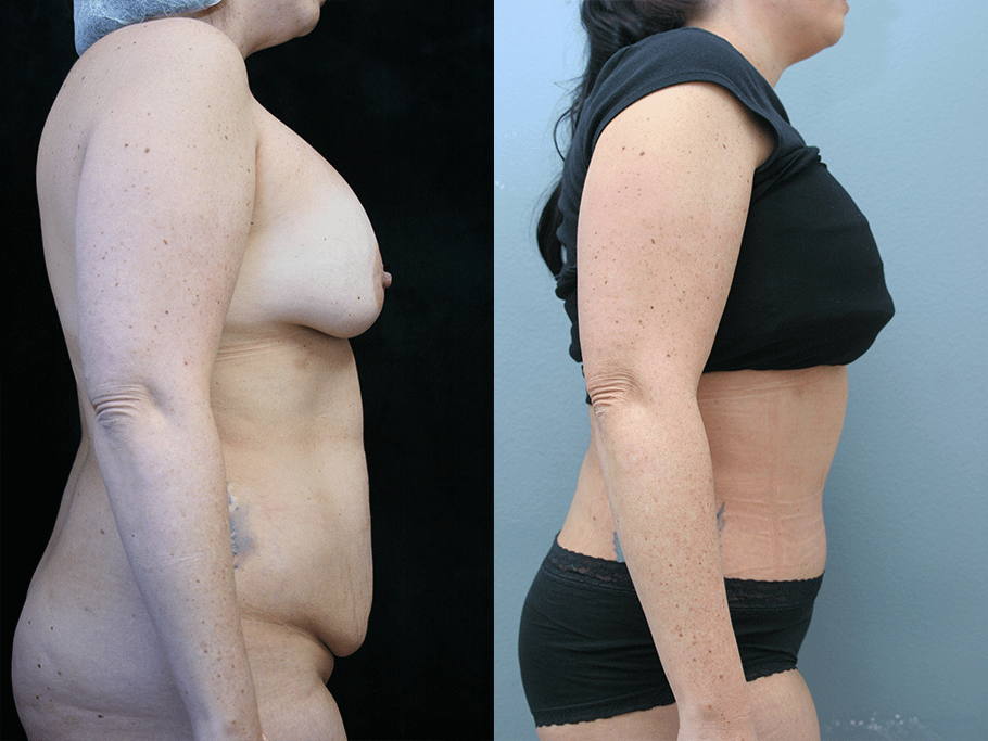 Tummy Tuck Before & After Photos Right Side