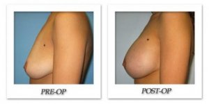 phoca_thumb_l_bruno-breast-augmentation-003