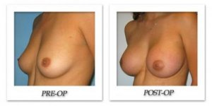 phoca_thumb_l_bruno-breast-augmentation-005