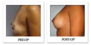 phoca_thumb_l_bruno-breast-augmentation-012