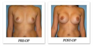 phoca_thumb_l_bruno-breast-augmentation-017