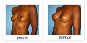 phoca_thumb_l_bruno-breast-augmentation-035