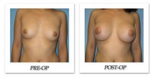 phoca_thumb_l_bruno-breast-augmentation-039