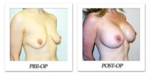 phoca_thumb_l_hodnett-breast-augmentation-024