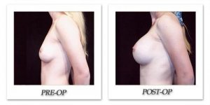 phoca_thumb_l_hodnett-breast-augmentation-patient11-side