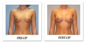 phoca_thumb_l_hsu-breast-augmentation-004