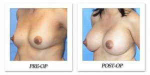 phoca_thumb_l_mandris-breast-augmentation-008