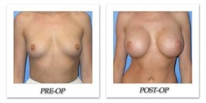 phoca_thumb_l_mandris-breast-augmentation-009