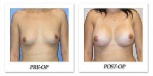 phoca_thumb_l_mandris-breast-augmentation-011