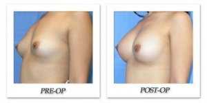 phoca_thumb_l_mandris-breast-augmentation-014