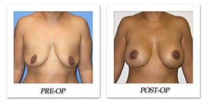 phoca_thumb_l_mandris-breast-augmentation-019