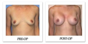 phoca_thumb_l_mandris-breast-augmentation-049