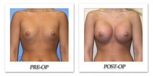 phoca_thumb_l_mandris-breast-augmentation-051