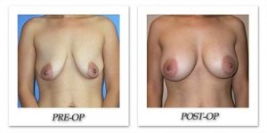 phoca_thumb_l_mandris-breast-augmentation-057