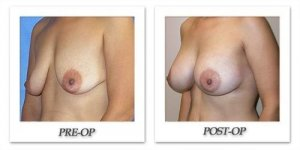 phoca_thumb_l_mandris-breast-augmentation-058