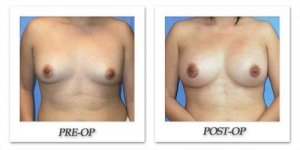 phoca_thumb_l_mandris-breast-augmentation-081