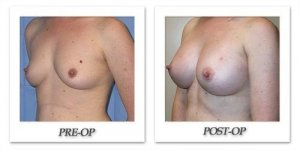 phoca_thumb_l_mandris-breast-augmentation-084