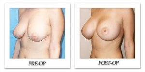 phoca_thumb_l_mandris-breast-augmentation-102