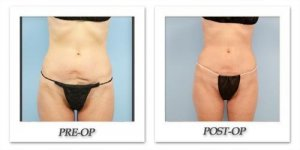 phoca_thumb_l_dr-begovic-liposuction-before-after-007