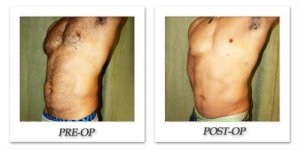 phoca_thumb_l_liposuction-before-after-016
