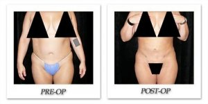 phoca_thumb_l_mandris-liposuction-035