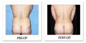 phoca_thumb_l_mandris-liposuction-036