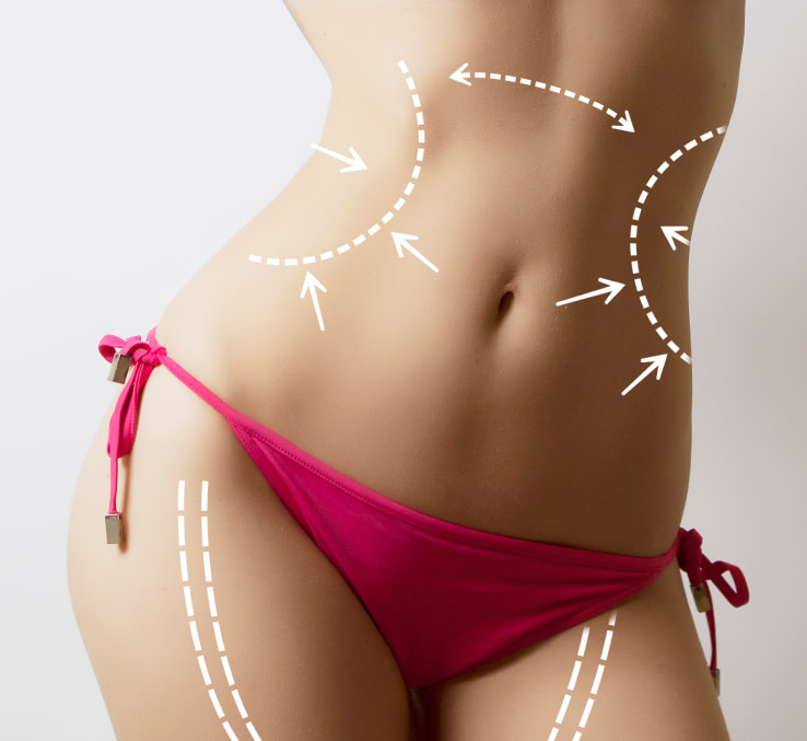 LIPOSUCTION results