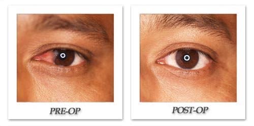 Pterygium: Eye Condition Highly Treatable with the Top Ophthalmologists of Beverly Hills Physicians