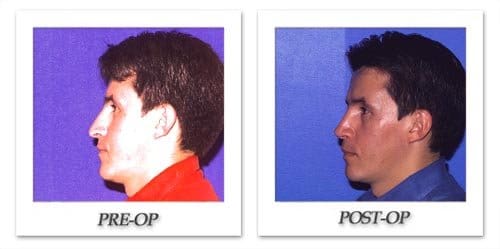 Rhinoplasty for Men: It’s Not as Plain as the Nose on Your Face, says Beverly Hills Physicians