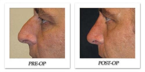 Men Seeking Plastic Surgery Are More Likely to Opt For Rhinoplasties than Women
